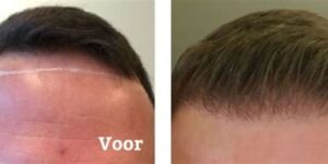 Haartransplantatie En Leeftijd: Wat De Juiste Leeftijd Is