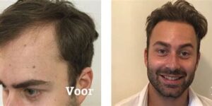 Het Belang Van Voeding Voor Haartransplantatie Resultaten