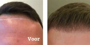 Voorbereidingen Voor Een Haartransplantatie: Checklist