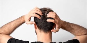 Wat Is Het Herstelproces Na Haartransplantatie?