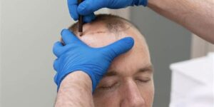 Haartransplantatie En De Psychologie Van Haarverlies