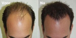 Wat Is Het Herstelproces Na Een Haartransplantatie?