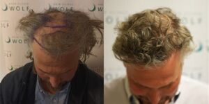 Haartransplantatie Voor En Na: Resultaten In Detail