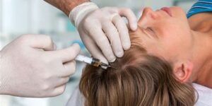 Wat Is Haartransplantatie En Hoe Werkt Het?