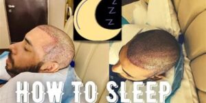 Haartransplantatie Na Zorg: Tips En Adviezen