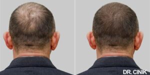 Haartransplantatie Resultaten: Wat Je Moet Weten