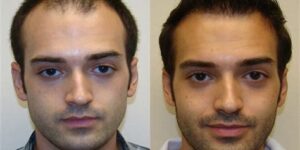 Haartransplantatie Voor En Na Foto's: Realistische Verwachtingen