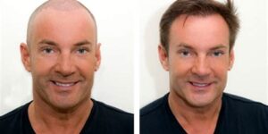 Haartransplantatie Voor En Na: Inspirerende Transformaties