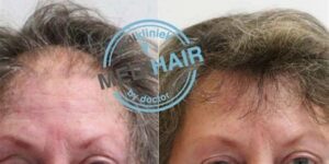Haartransplantatie Voor Vrouwen: Wat Je Moet Weten