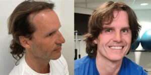 Effecten Van Haartransplantatie: Mijn Persoonlijke Ervaring