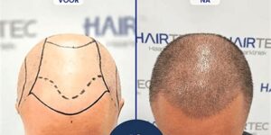 Haartransplantatie Voor Politieke Beroepsgroepen: Een Case Study
