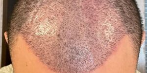 Saffier FUE: Voordelen Voor Jouw Haartransplantatie