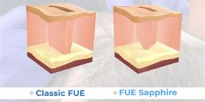 Saffier FUE Vs. Traditionele Methoden: Wat Is Beter?